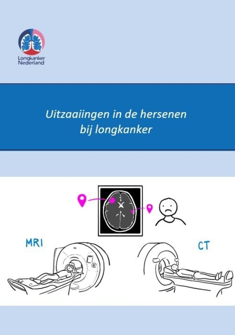 Uitzaaingen in de hersenen bij longkanker