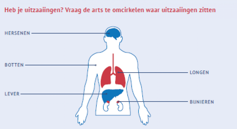 Omcirkel waar de uitzaaiingen zitten